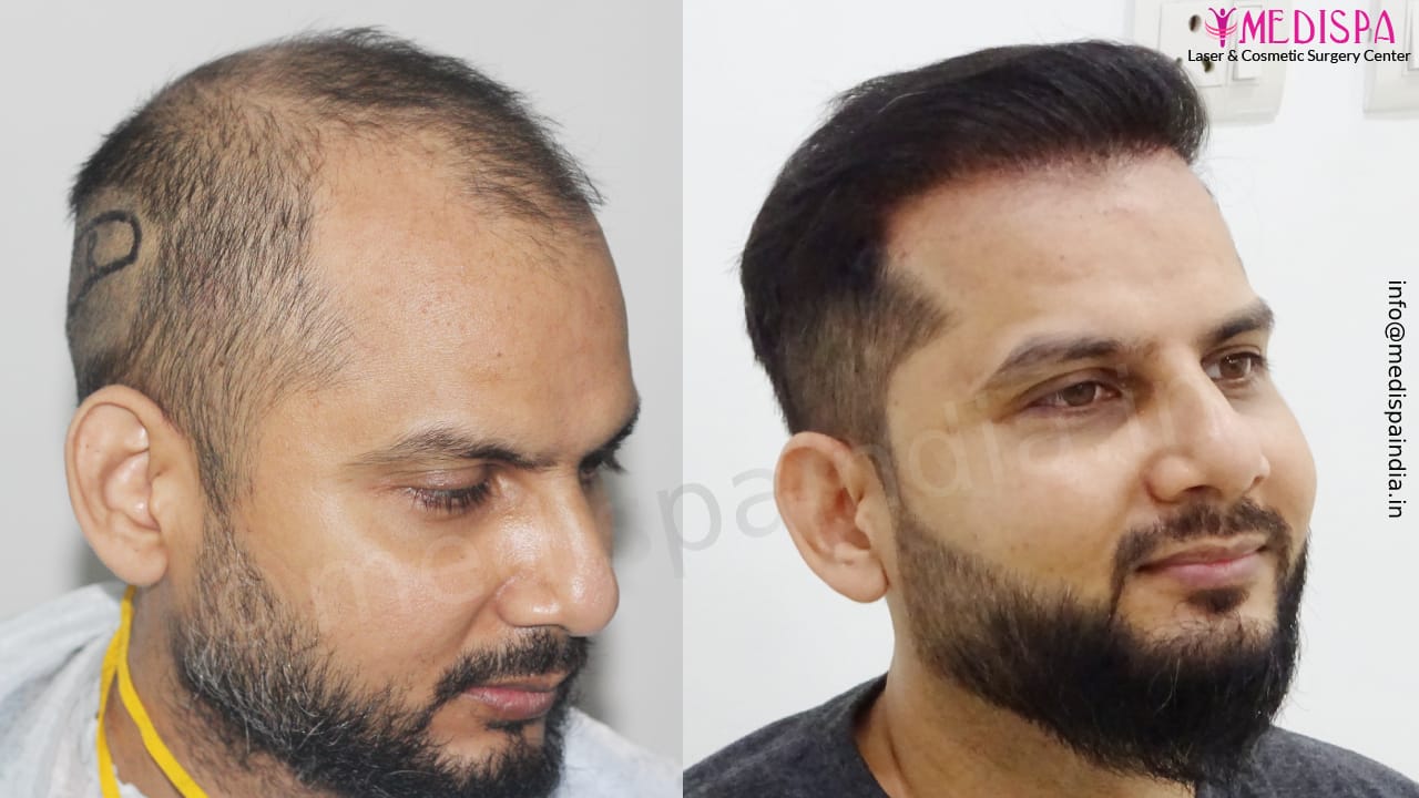 Hair Patch in Delhi Best Hair Patch Clinic in New Delhi