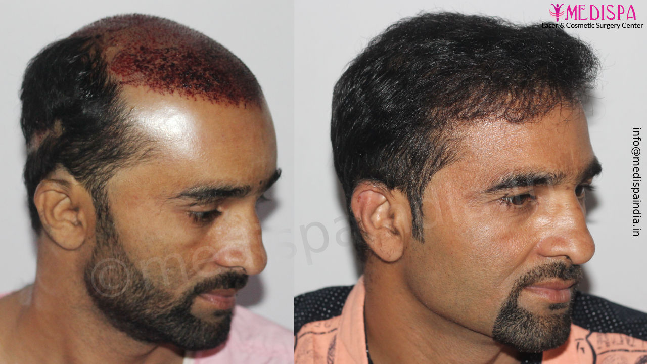 Hair Restoration India Results