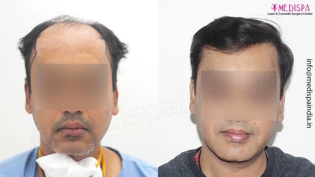 Hair Transplant In Vellore