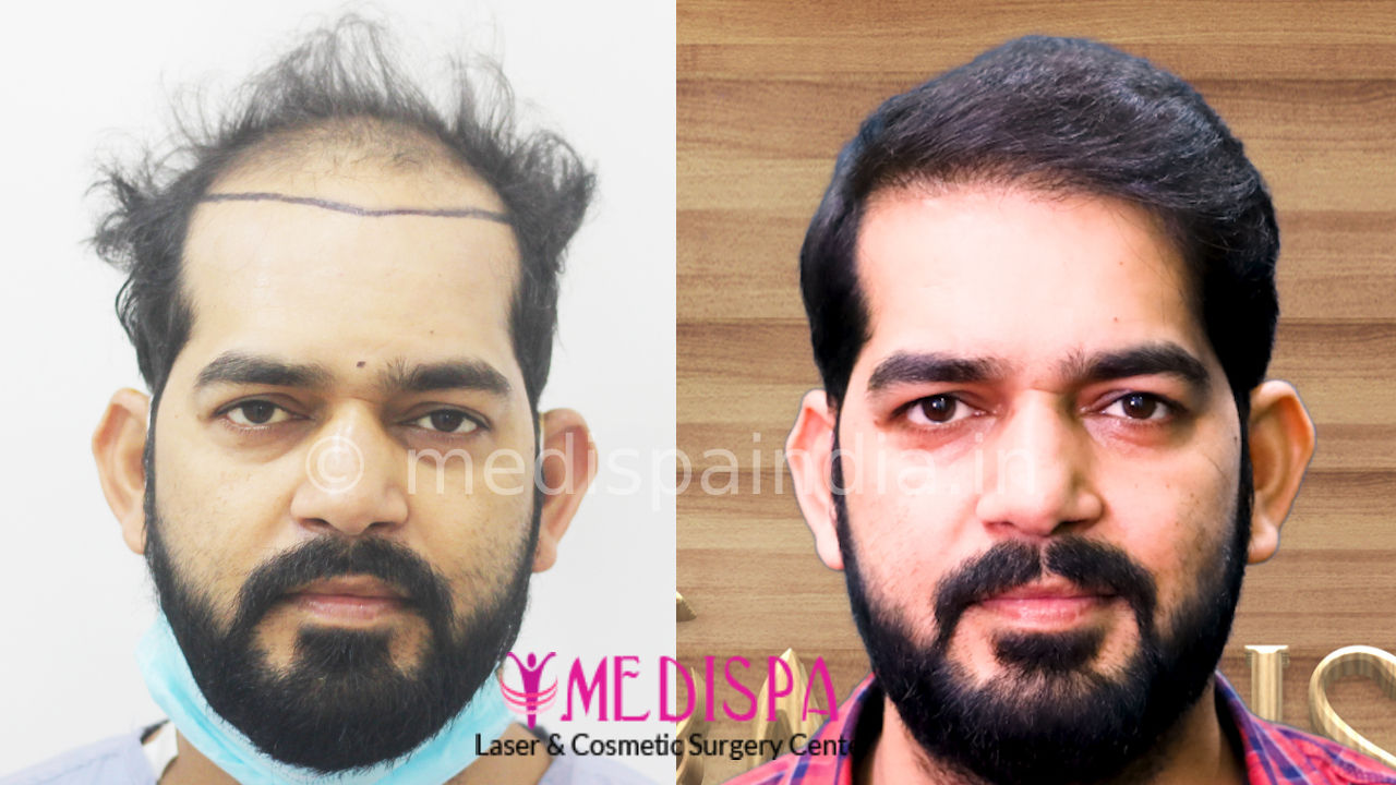 International Hair Transplant Results  Medispa India