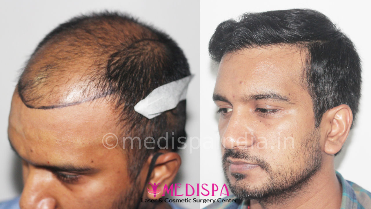 Hair Transplant Results in India Hair Transplant Results in India