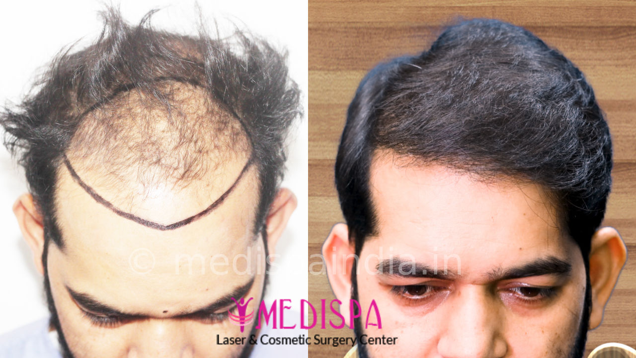 High density best hair transplant in India at AKESO Clinic  Delhi  Better  than turkey  istambul  YouTube