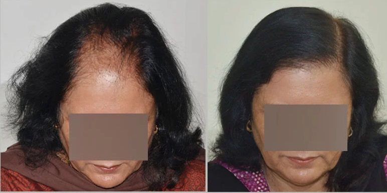 Expert Hair Transplant and Restoration Solutions for Women in India