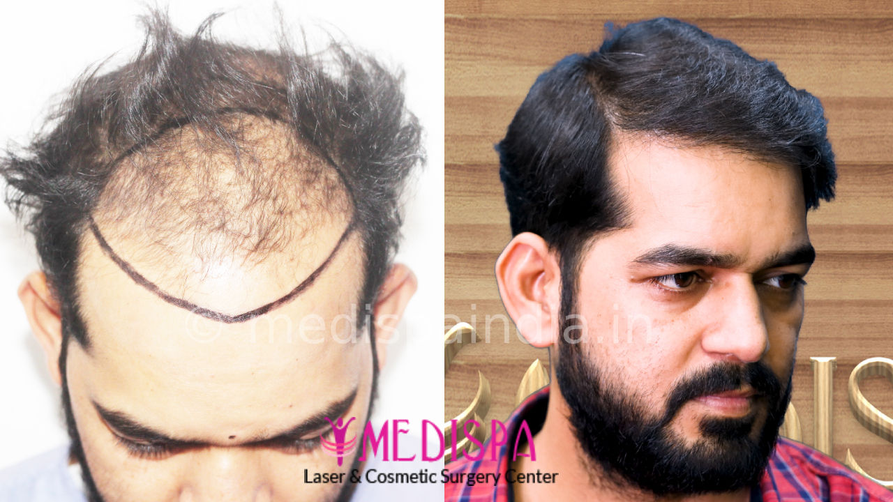 Best Hair Transplant Results in Delhi