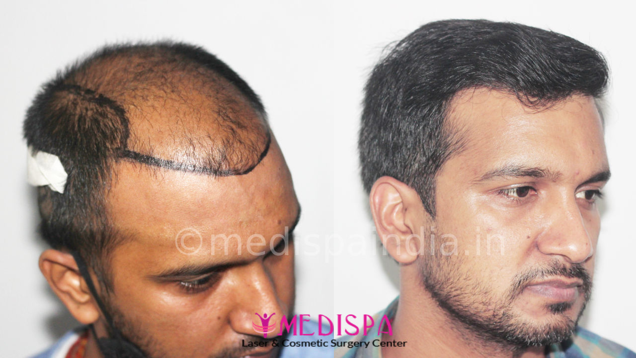 Hair Transplant Results in India