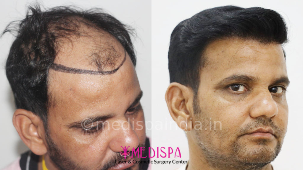 Best Hair Transplant Results in India Gallery