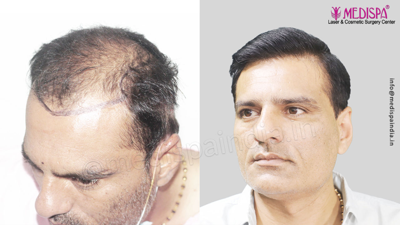 Best hair transplant results in Rajasthan