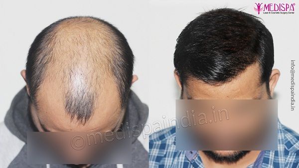 How it feels to have a hair transplant