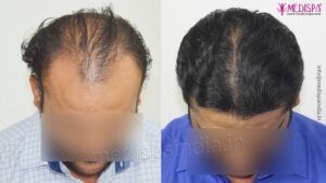 Hair Transplant in India  Best Result  Cost  Medispa India  Celebrity  MIHIR Mishra  YouTube