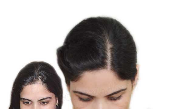 Hair Transplant In Jaipur Hair Transplant Cost In Jaipur 