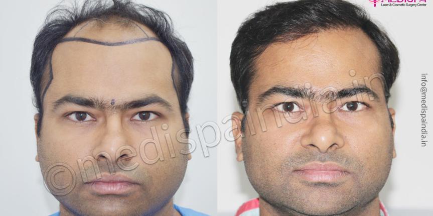 hair transplant cost in uk hair transplant cost in uk