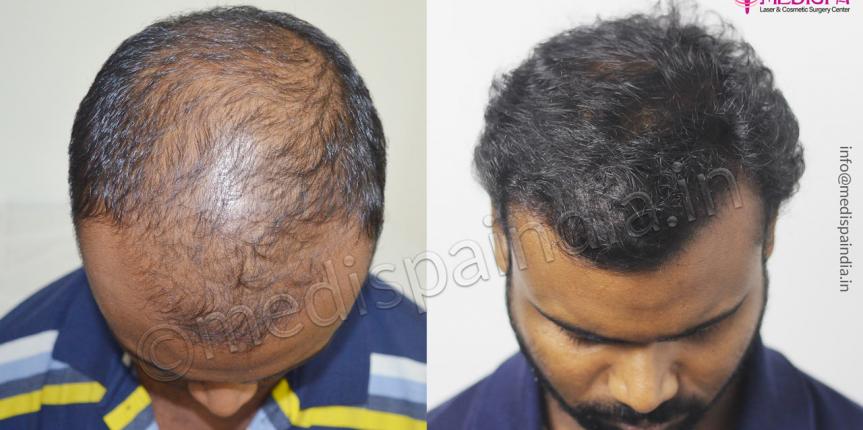hair transplant in kerala