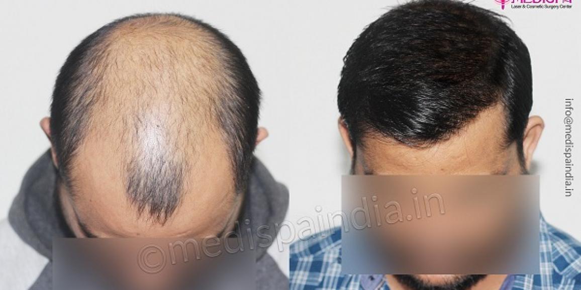 Best Hair Transplant Doctor in India  Dr Suneet Soni