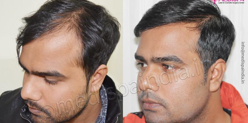 chennai hair transplant