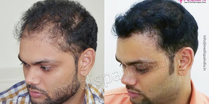 3 Best Hair Transplant Surgeons in Mumbai MH  ThreeBestRated