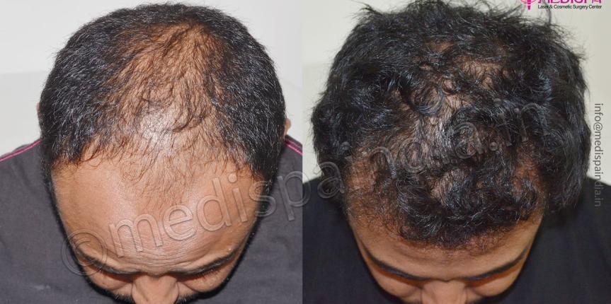 best hair transplant surgeons in dehradun best hair transplant surgeons in dehradun