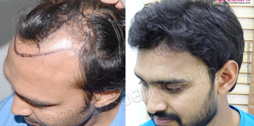 Best Hair Transplant Surgeons Near Madhapur Hyderabad at Cyber Hair Sure  Clinic  Cyber Hairsure