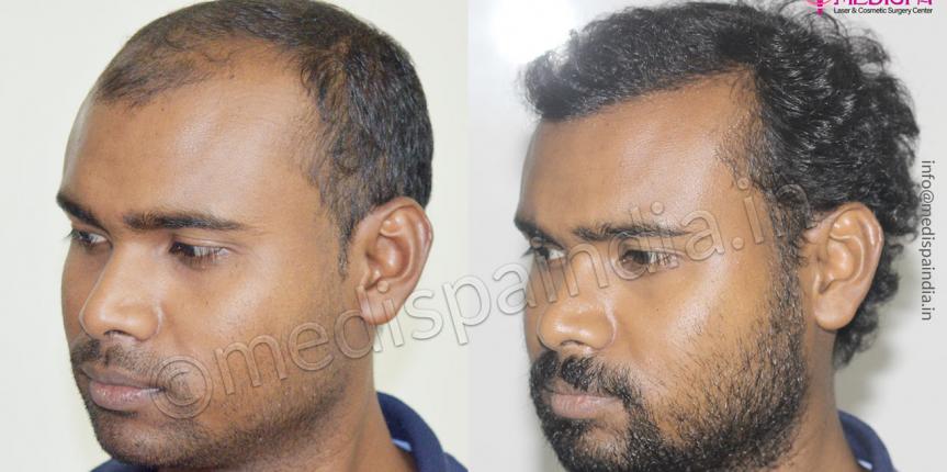 Hair Transplant Results After 10 Months at Medispa India