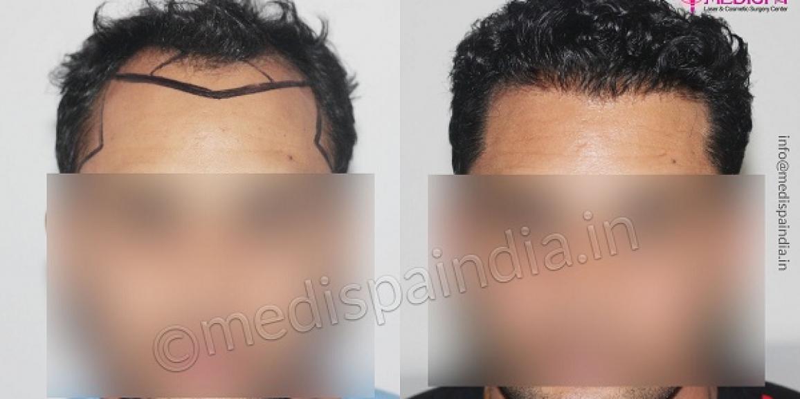 Men Hair Transplant  Vernon Skin and Hair Clinic
