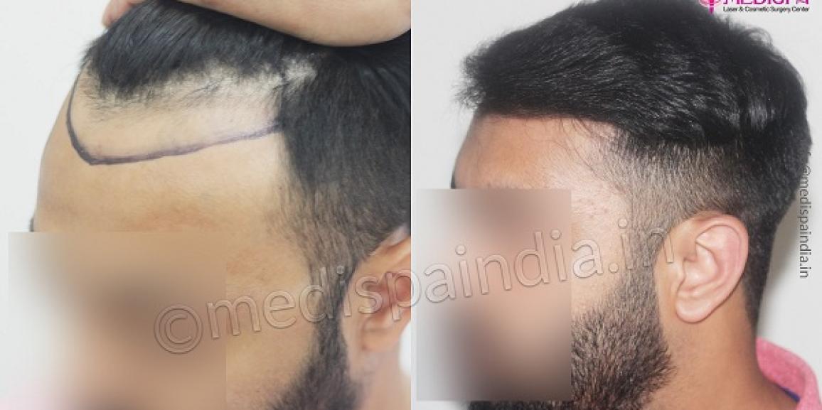 Hair Transplant DHI Technique