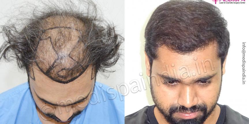 Highdensity Hair Transplantation Navi Mumbai