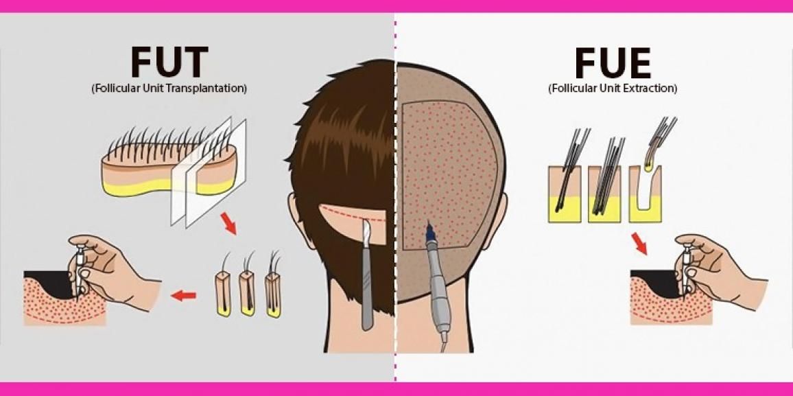 FUT  FUE Combined Hair Transplant Technique Vizag