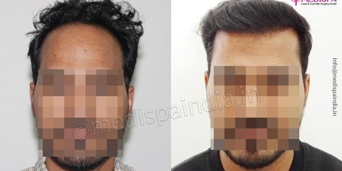 Explain The Techniques That Provide The Best Hair Transplant Treatment Explain The Techniques That Provide The Best Hair Transplant Treatment