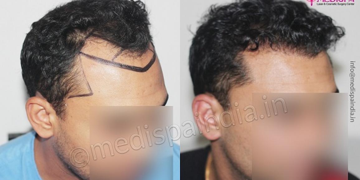 Hair loss in the hairline area and sides treated with FUE hair transplant  in Jaipur