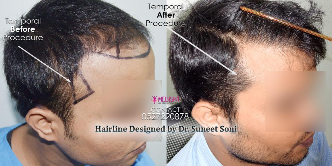 Nashville Hair Doctor - Hair Transplants by Experts