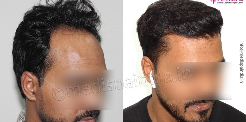 cost-of-hair-transplant-in-delhi-india cost-of-hair-transplant-in-delhi-india
