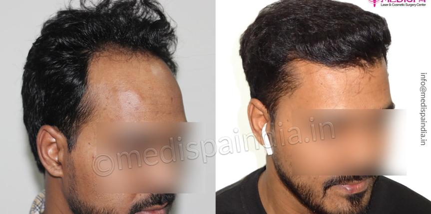 Hair Transplant Surgery Results Before and After Photos  Top Hair  Transplant Center Delhi Jaipur  Hair Transplant Cost India