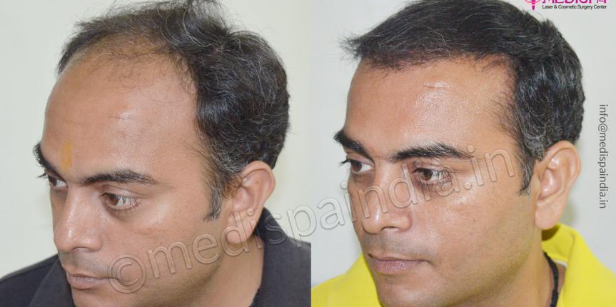 Best Hair Transplant Clinic in Surat  Hair N Images Clinic