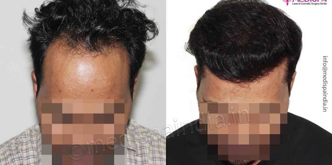 FUT hair transplant 500 Grafts  Satya Hair Transplant Clinic