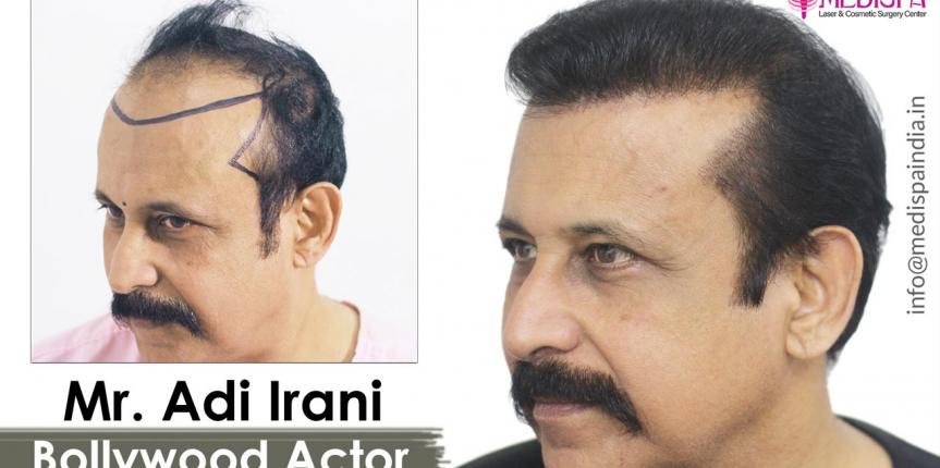 bollywood-celebrity-hair-transplant