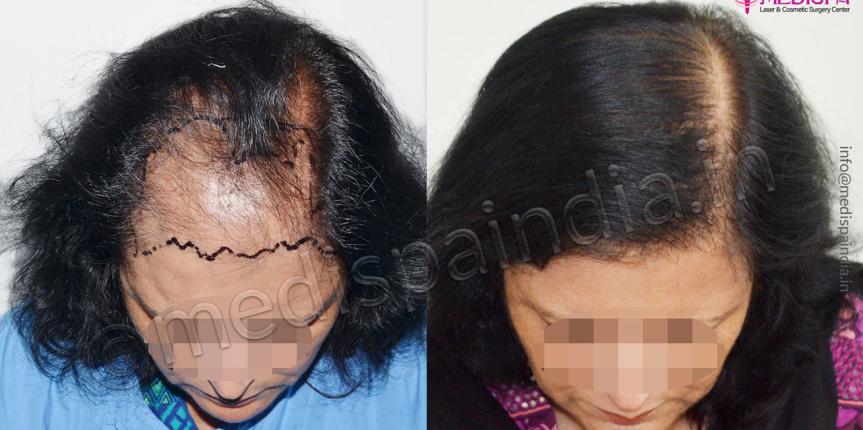 hair transplant doctors in greater kailash south delhi hair transplant doctors in greater kailash south delhi