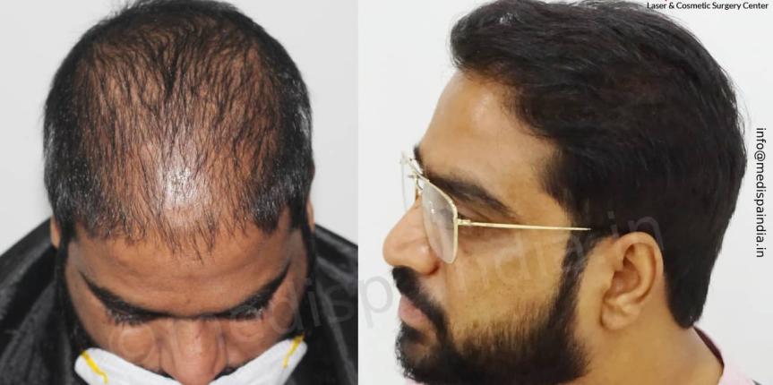 hair transplant cost in bangalore hair transplant cost in bangalore