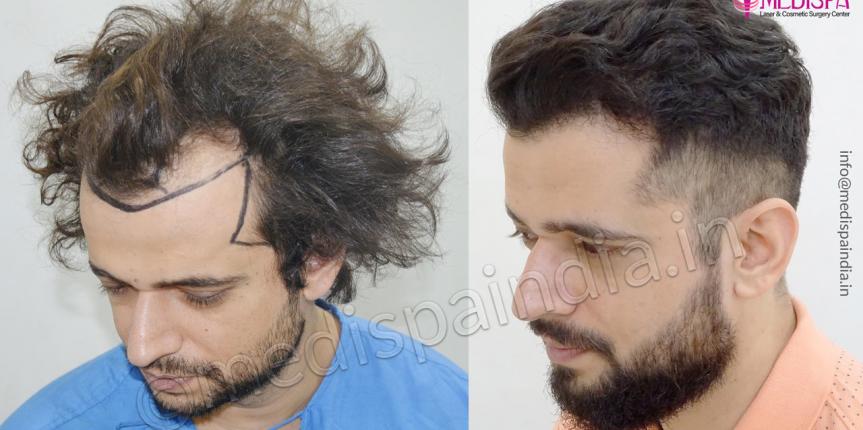 5000 Grafts Hair Transplant  Operation and Cost  Heva Clinic