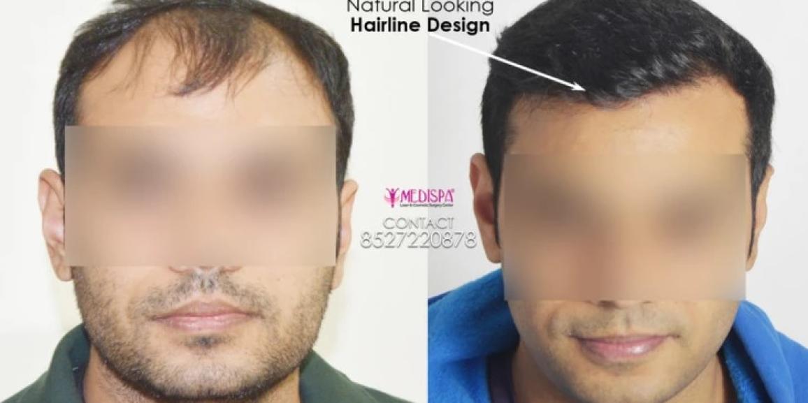 How Does Hair Transplant Work Explain With Advantages