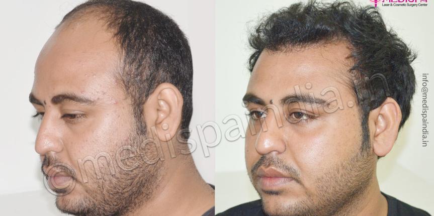 Hair Transplant Doctors in Dehradun  View Cost Book Appointment Consult  Online