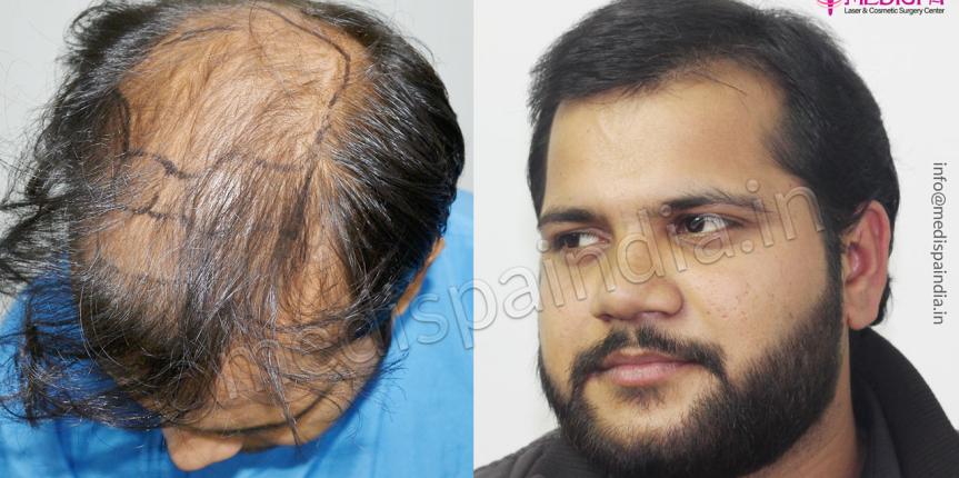 hair transplant cost Hyderabad hair transplant cost Hyderabad