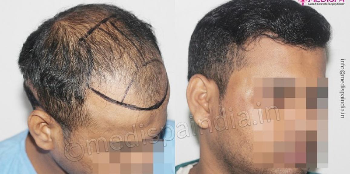 FUE or FUT The Best Hair Transplant Technique  Artius Hair Transplant