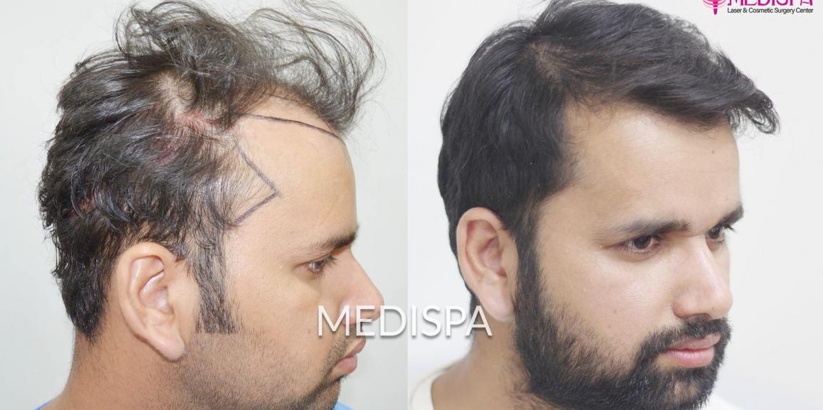 What are the Possible Side-Effects Associated with a Hair Transplant