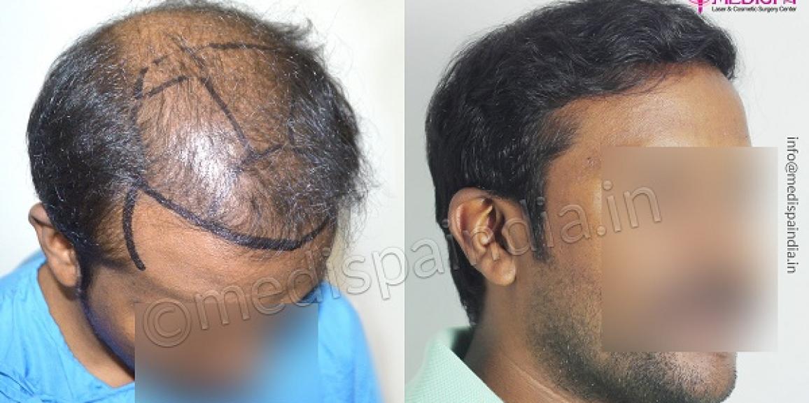 Is Hair Restoration A Successful Treatment For Hair Loss? Is Hair Restoration A Successful Treatment For Hair Loss?