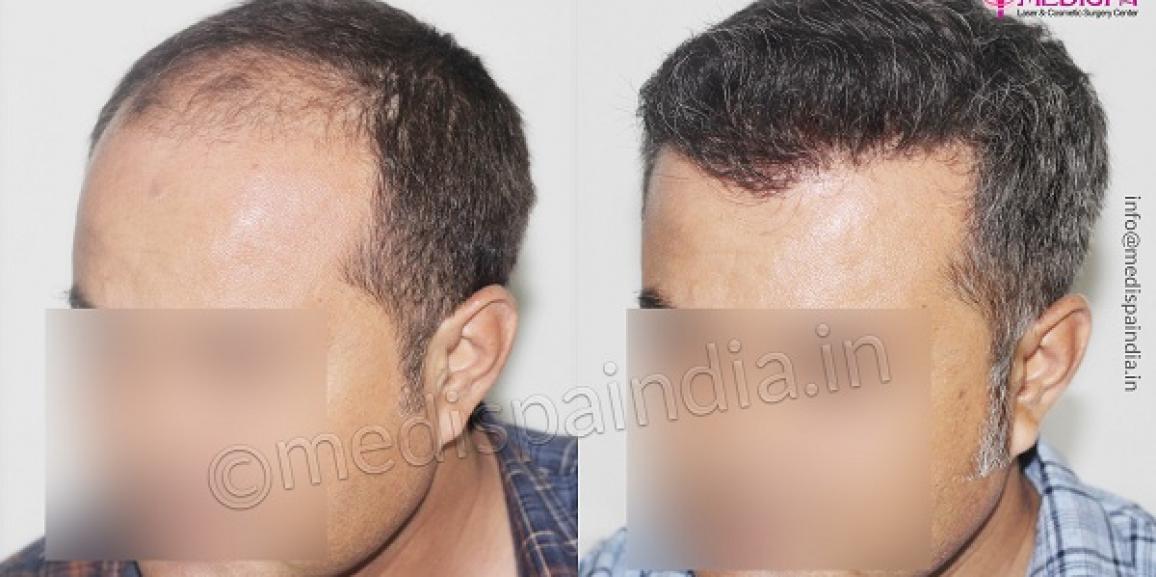 DHI Hair Transplant 35014000 Grafts  Dr Serkan Aygin Clinic