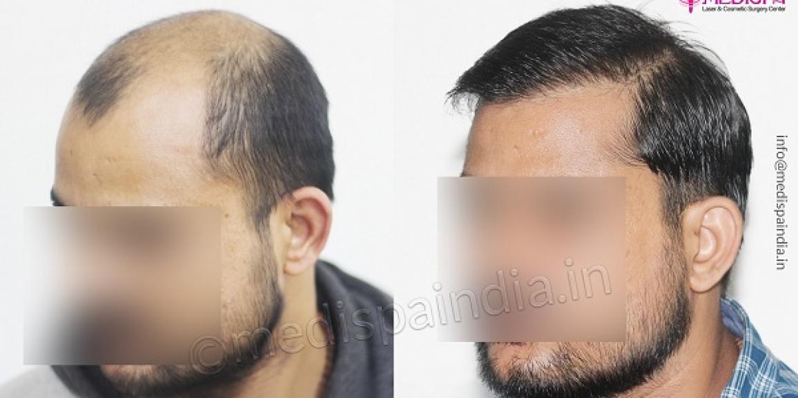 Fue 3500 Grafts hair transplant Pakistan Cosmoderma Clinic Lahore  DrAhmad Chaudhry