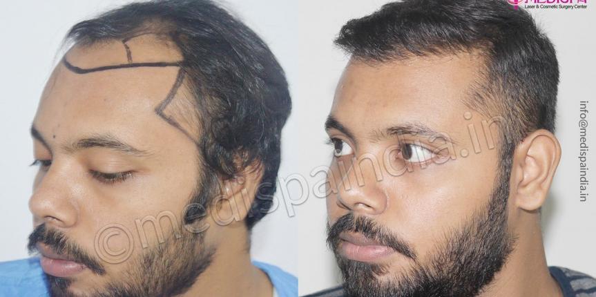 Hair Transplant Cost in India Get the Best Price for 2023