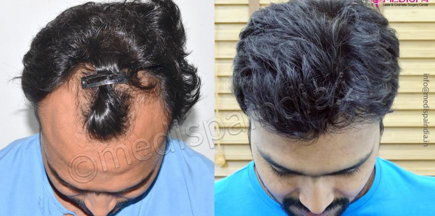 Anagen Hair Transplant Hair Transplant Surgery Clinic in Andheri West  Mumbai  Book Appointment View Fees Feedbacks  Practo