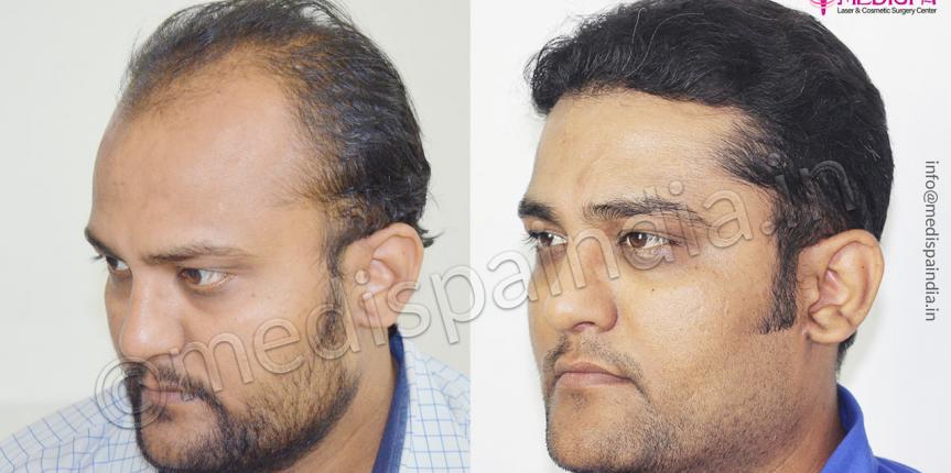 Hair Transplant in Bangladesh, Hair Transplant Cost