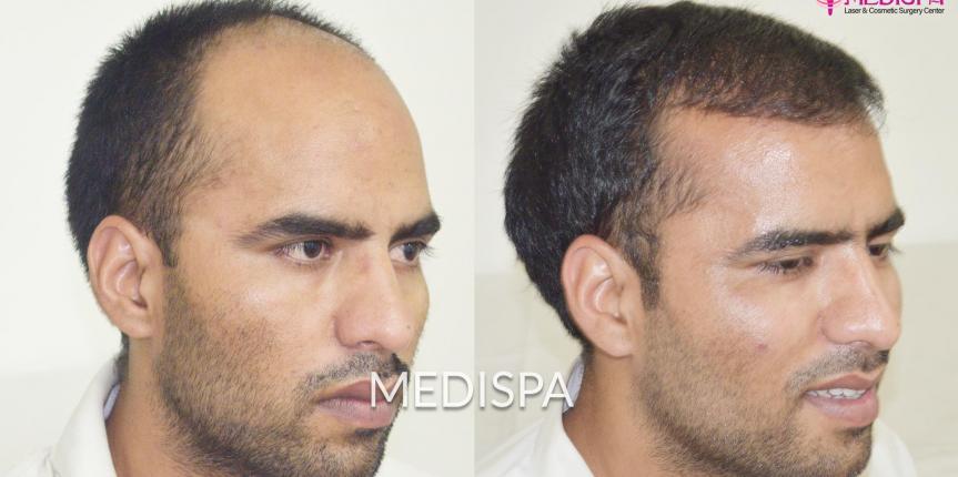 Best Hair Transplant in Mumbai Navi Mumbai  La Densitae