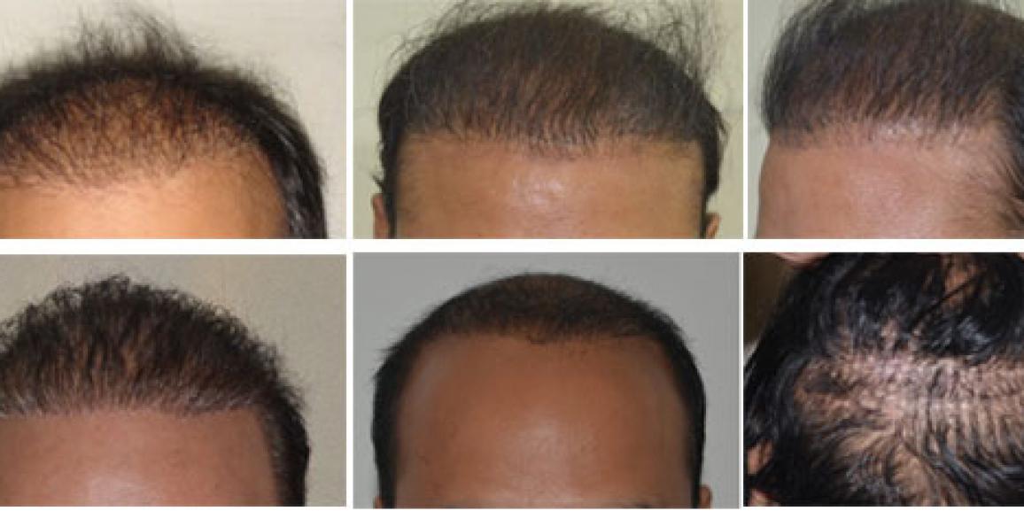 What causes a hair transplant to fail  Quora